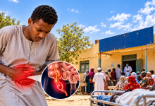 التهاب الزائدة الدودية
